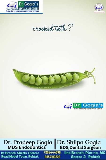 Close-up of crooked teeth before orthodontic treatment at Dr. Gogia's Super Specialty Dental Care Centre, Rohtak