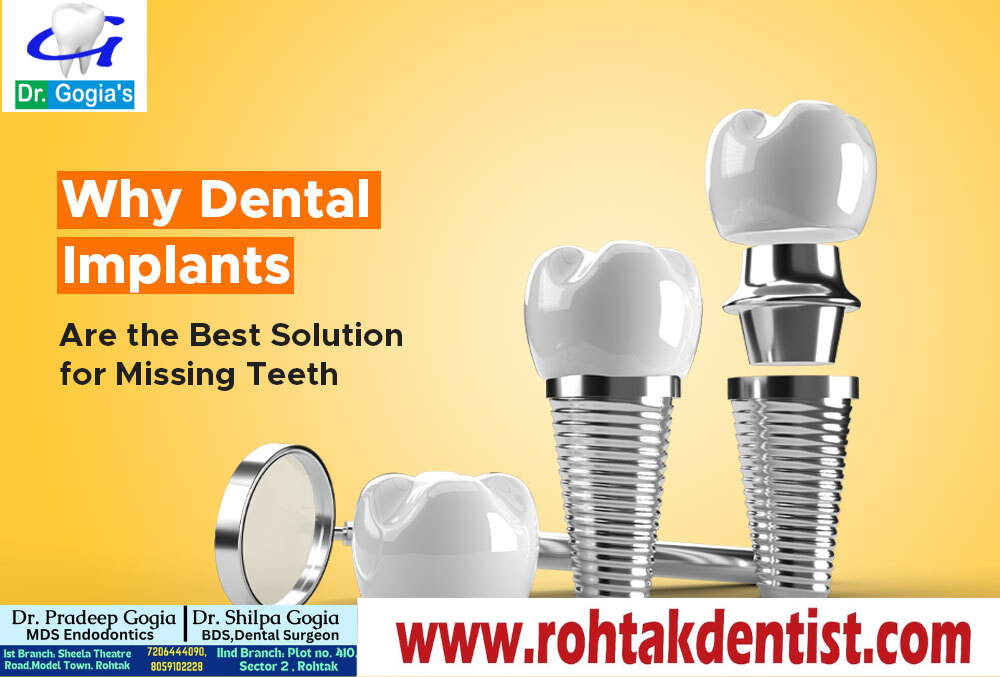 Permanent solution for missing teeth with dental implants at Dr. Gogia Dental Clinic Rohtak