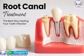 Painless root canal treatment to save damaged tooth