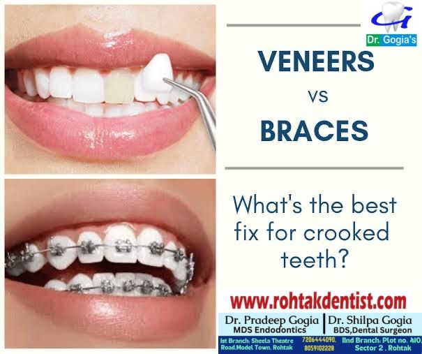 Veneers vs Braces comparison for crooked teeth treatment at Dr. Gogia’s Super Specialty Dental Care Centre Rohtak